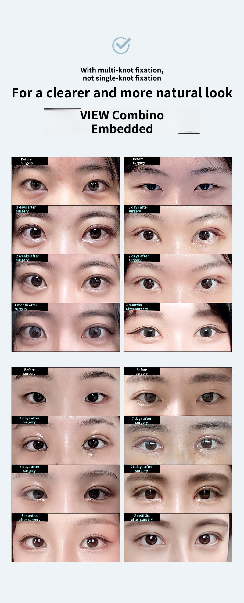 ❤️View❤️Eye Surgery