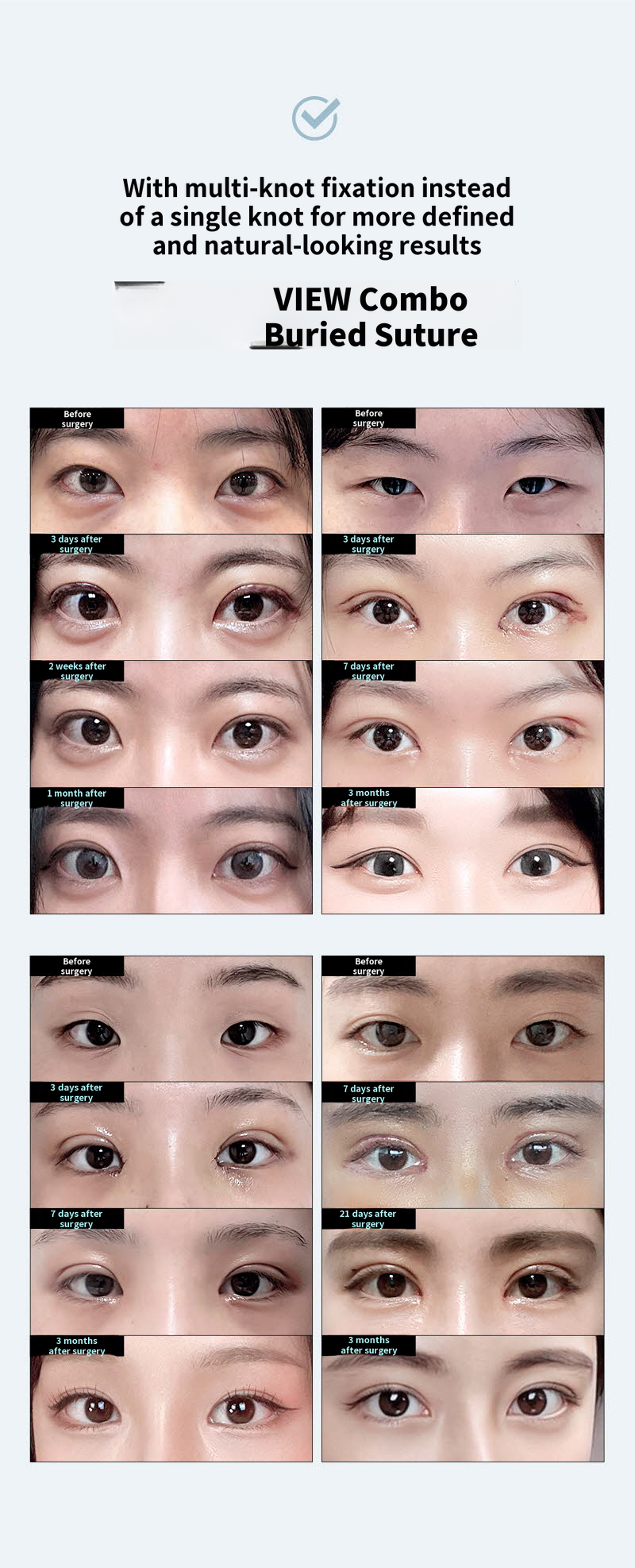 ❤️VIEW❤️ Eye Surgery