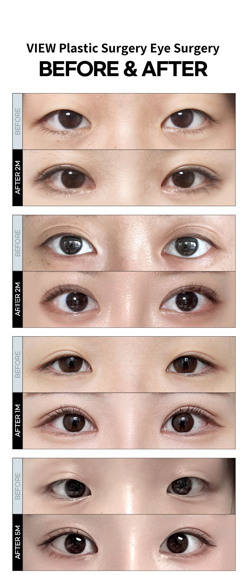 ❤️View❤️Eye Surgery