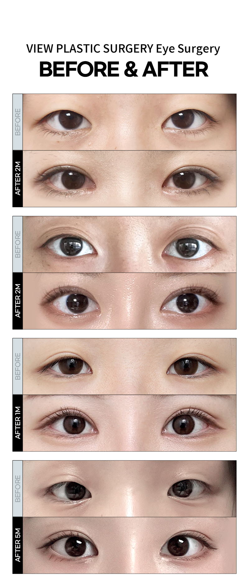 ❤️VIEW❤️ Eye Surgery