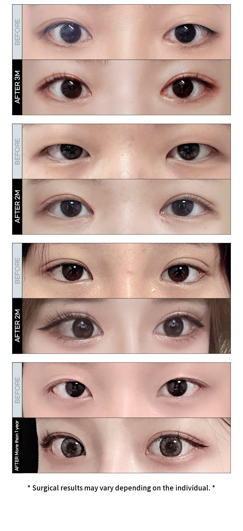 ❤️View❤️Eye Surgery