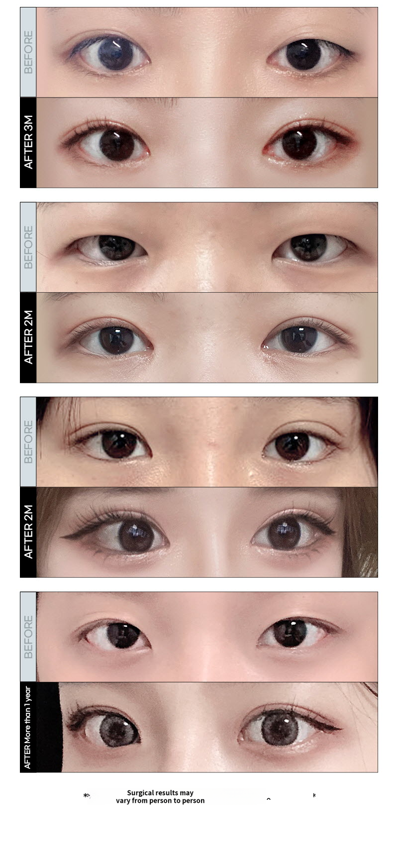 ❤️VIEW❤️ Eye Surgery