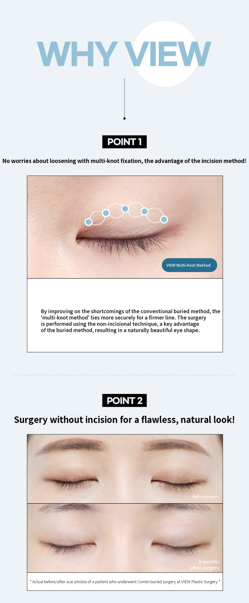 ❤️View❤️ Eye Enhancement Surgery