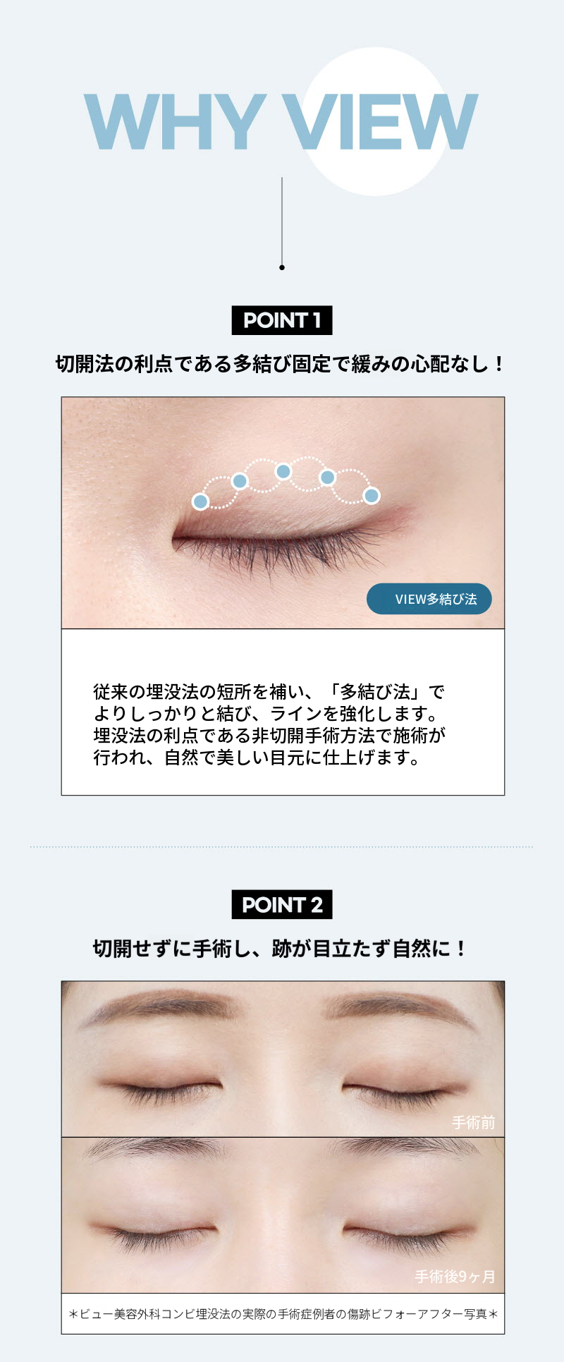 ❤️ビュ❤️目の形成