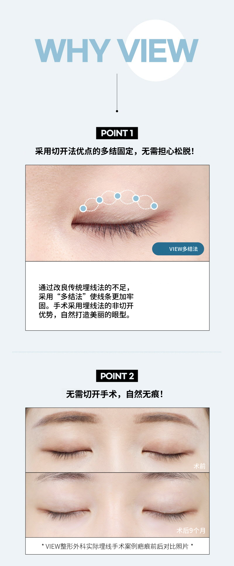 ❤️美丽❤️眼睛整形