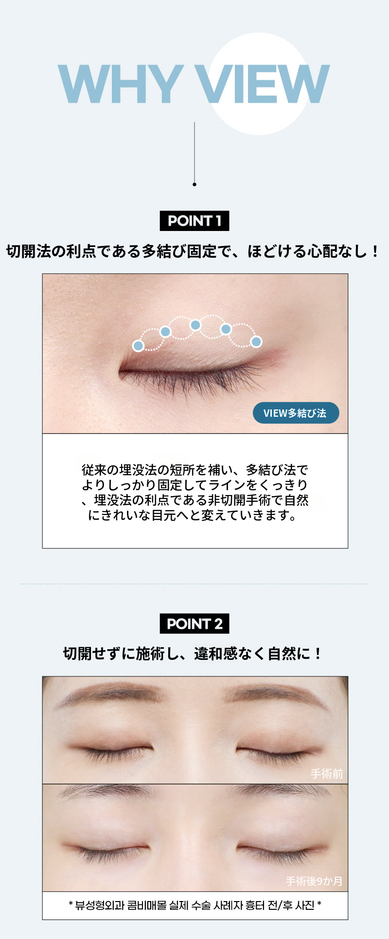 ❤️ビュー❤️目の整形