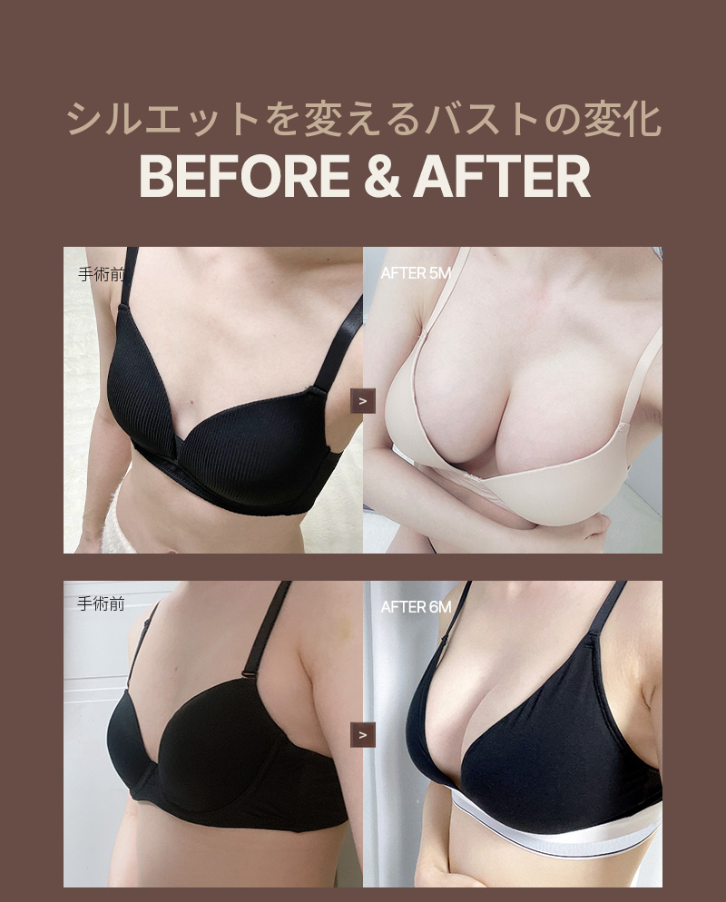 ❤️ビュー❤️UIU 豊胸手術