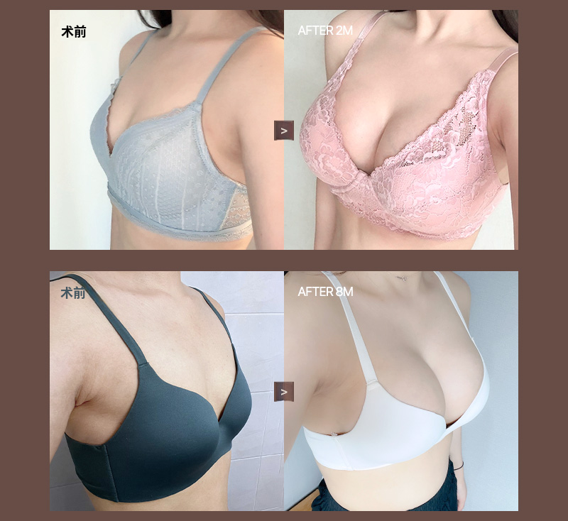 ❤️VIEW❤️UIU 隆胸手术