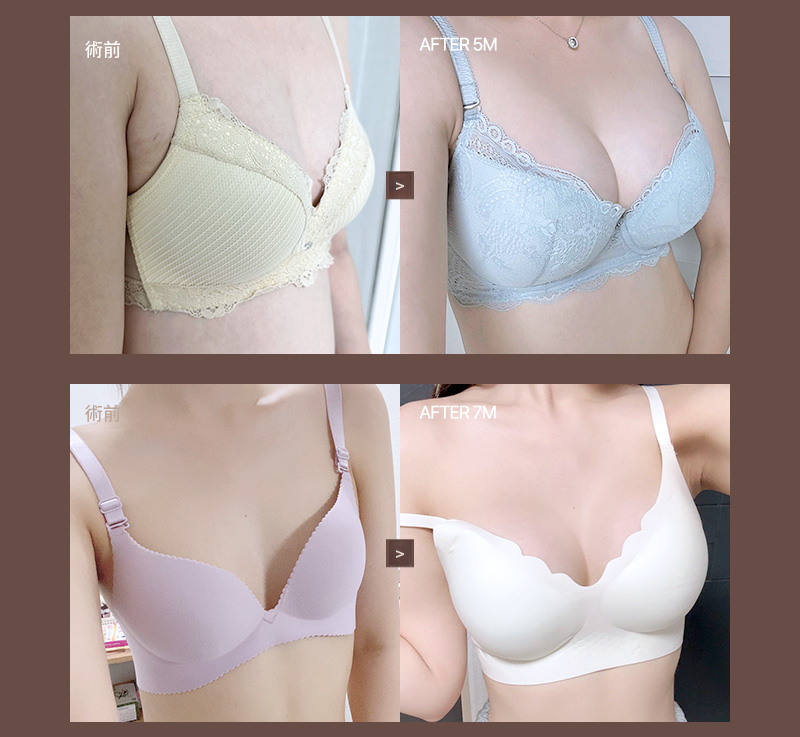 ❤️ビュー❤️UIU 豊胸手術