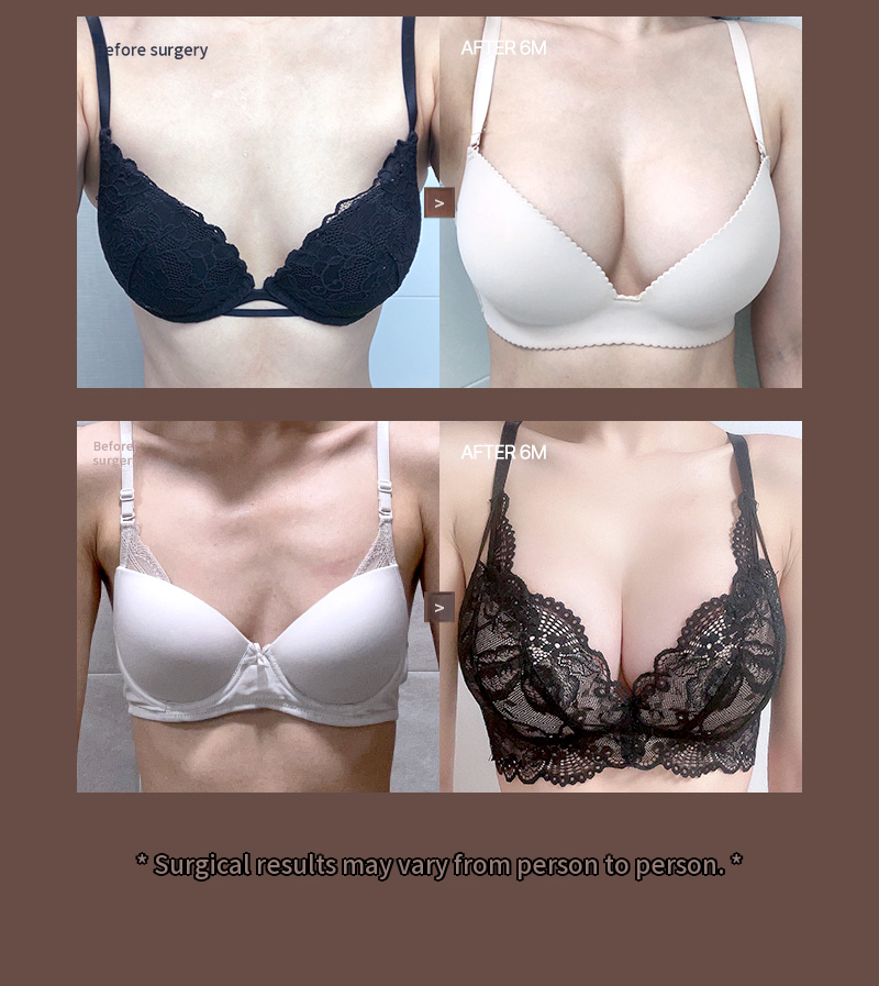 ❤️VIEW❤️ UIU Breast Augmentation Surgery