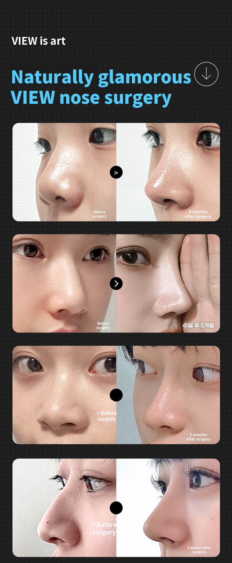 ❤️View❤️Nose Surgery