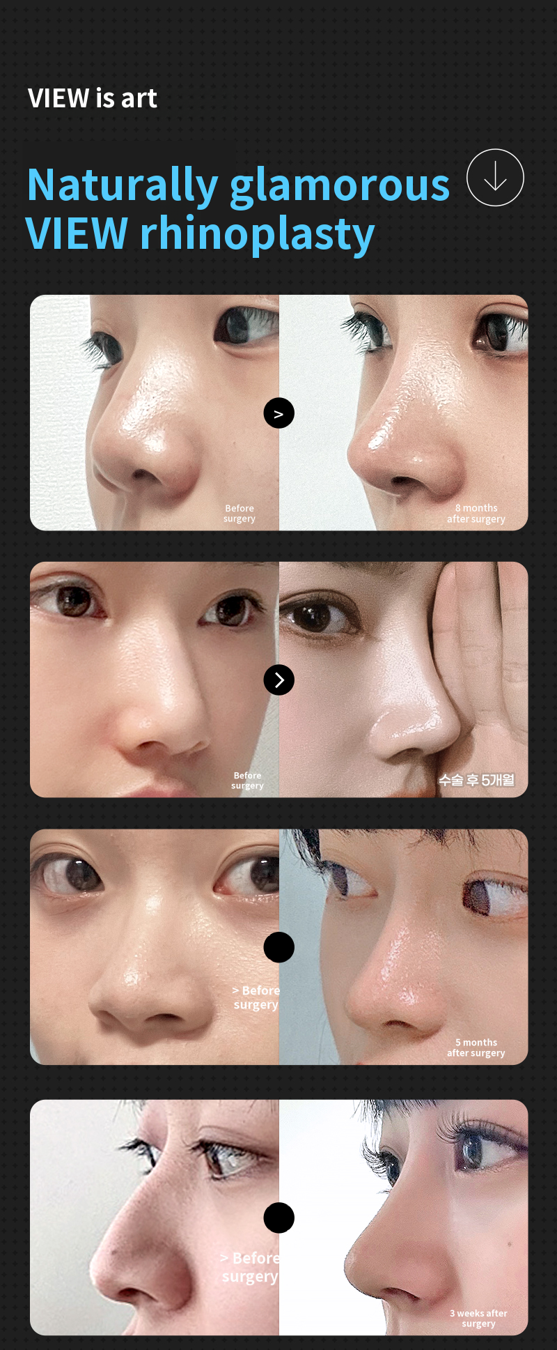 ❤️View❤️ Rhinoplasty
