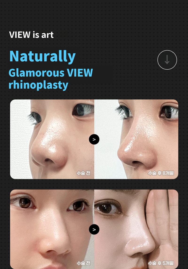 ❤️View Rhinoplasty❤️