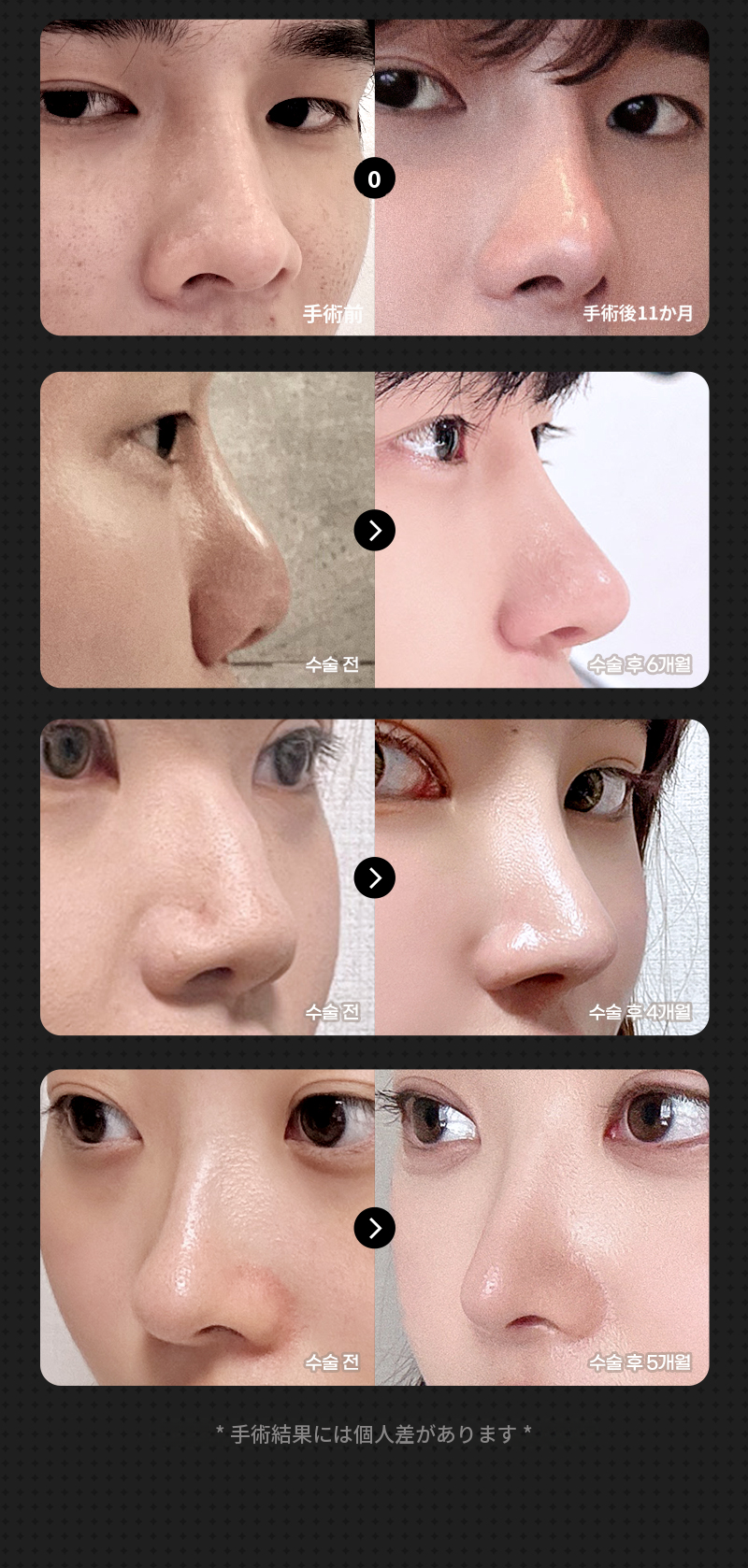 ❤️ビュー❤️鼻整形