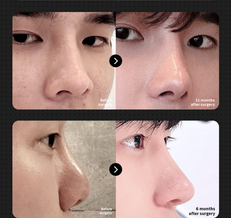 ❤️View Rhinoplasty❤️