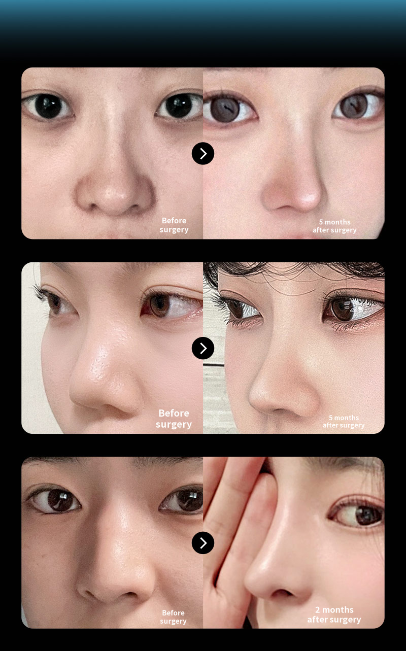 ❤️View Rhinoplasty❤️