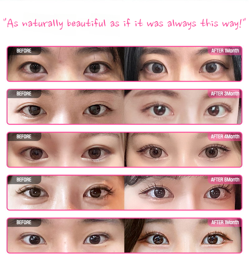 ❤️View❤️ Eye Surgery Revision