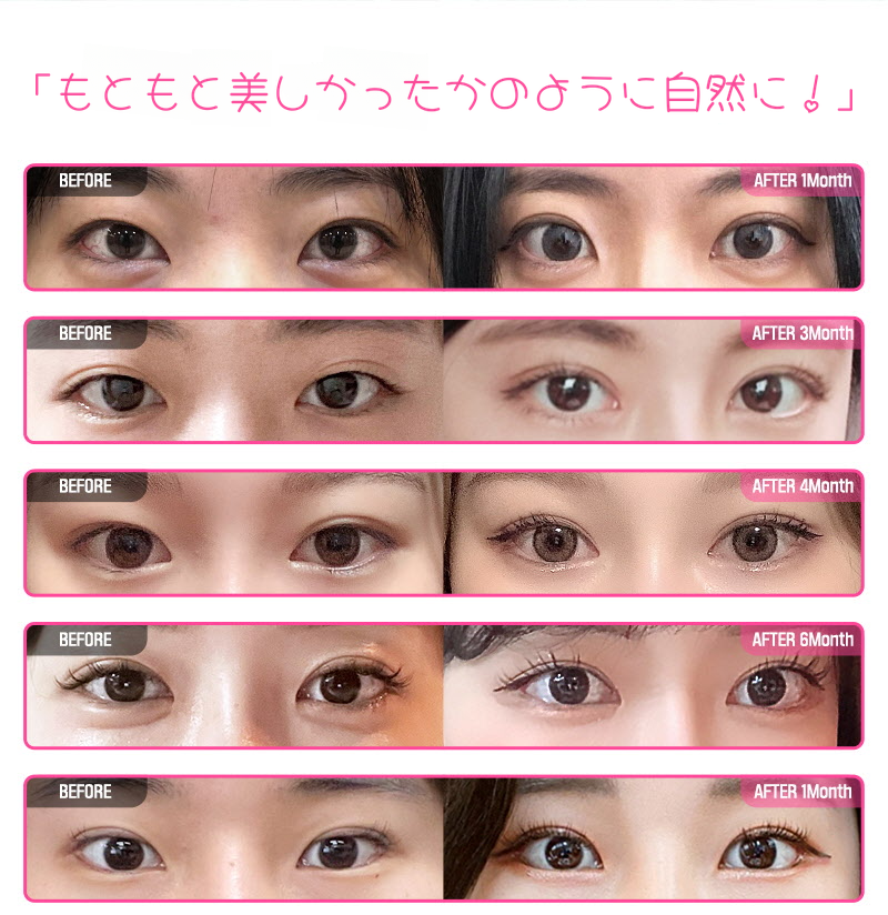 ❤️ビュ❤️目の再手術
