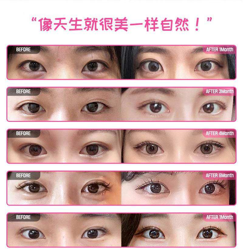 ❤️美丽❤️眼睛重建手术