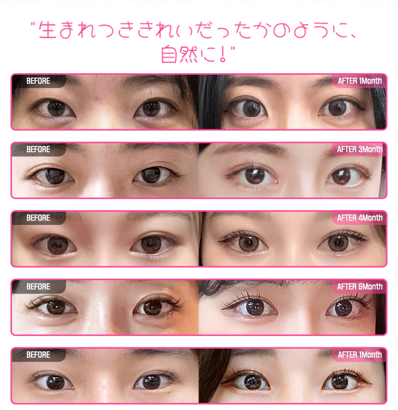 ❤️ビュー❤️目の再手術
