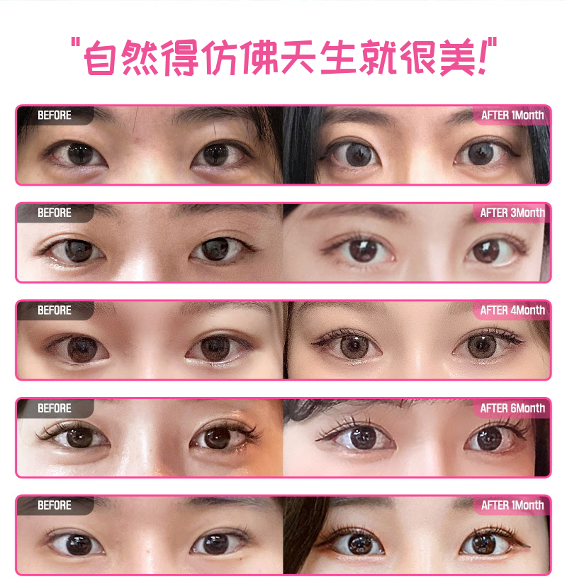 ❤️视觉❤️眼睛再手术