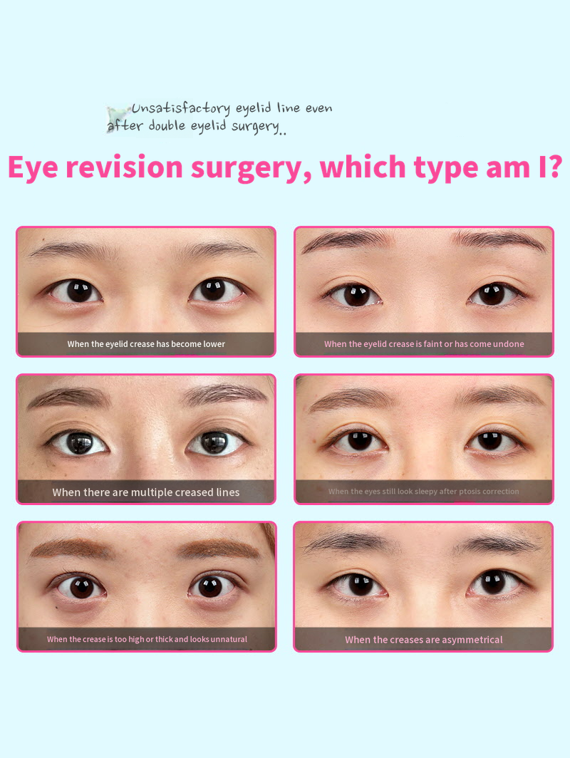 ❤️View❤️ Eye Surgery Revision