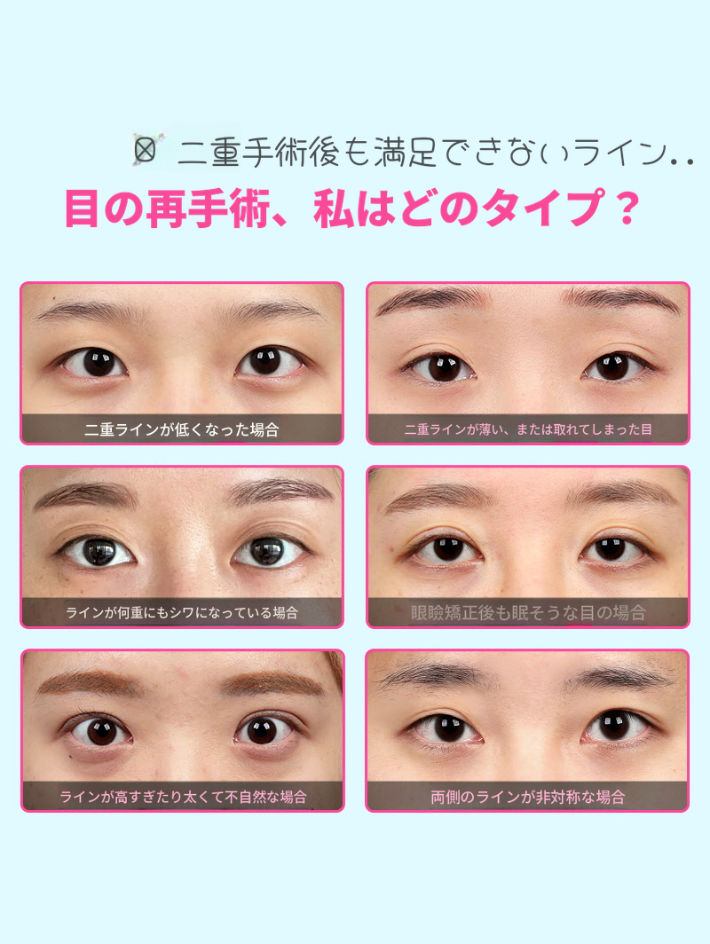 ❤️ビュ❤️目の再手術