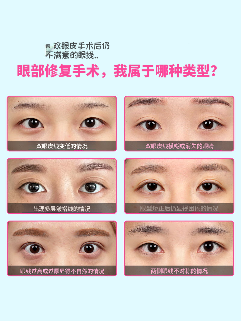 ❤️美丽❤️眼睛重建手术