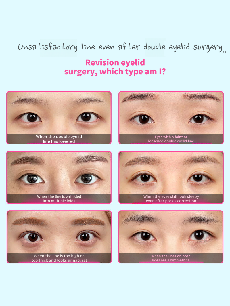 ❤️View❤️Eye Reoperation