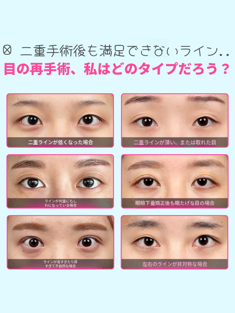 ❤️ビュー❤️目の再手術