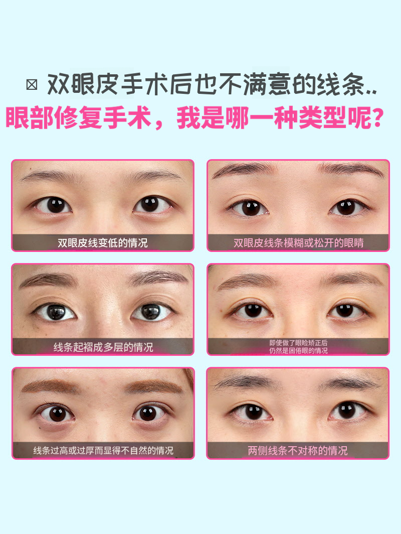 ❤️视觉❤️眼睛再手术