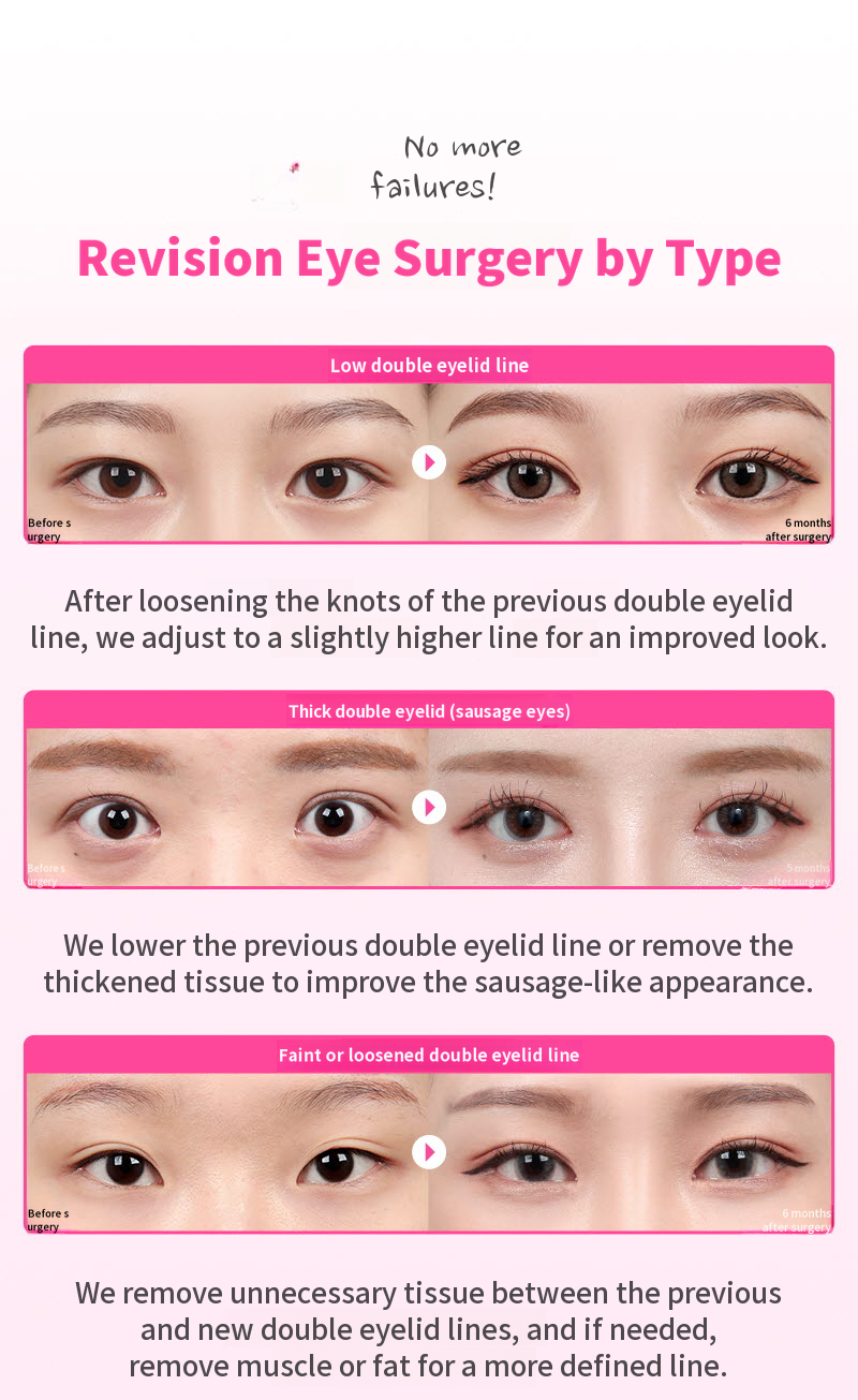 ❤️View❤️ Eye Surgery Revision