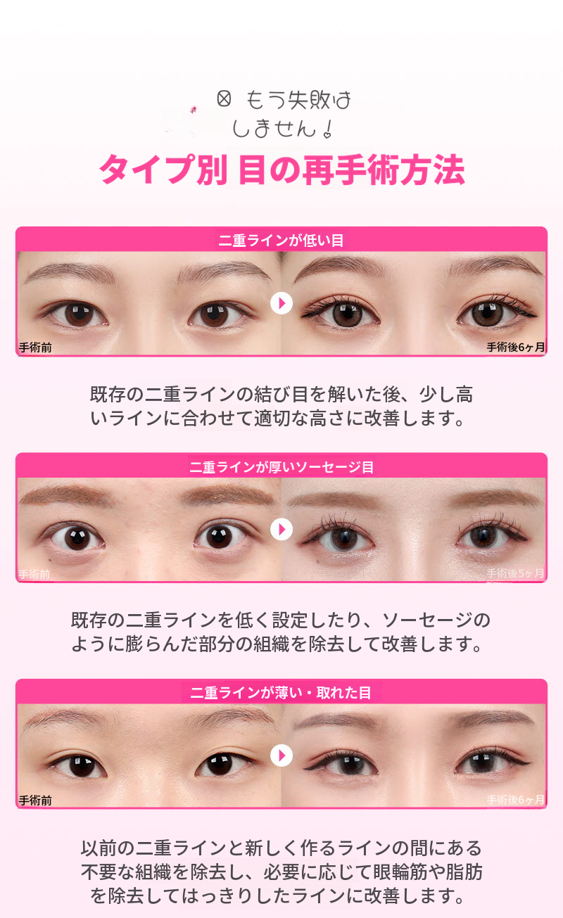 ❤️ビュ❤️目の再手術