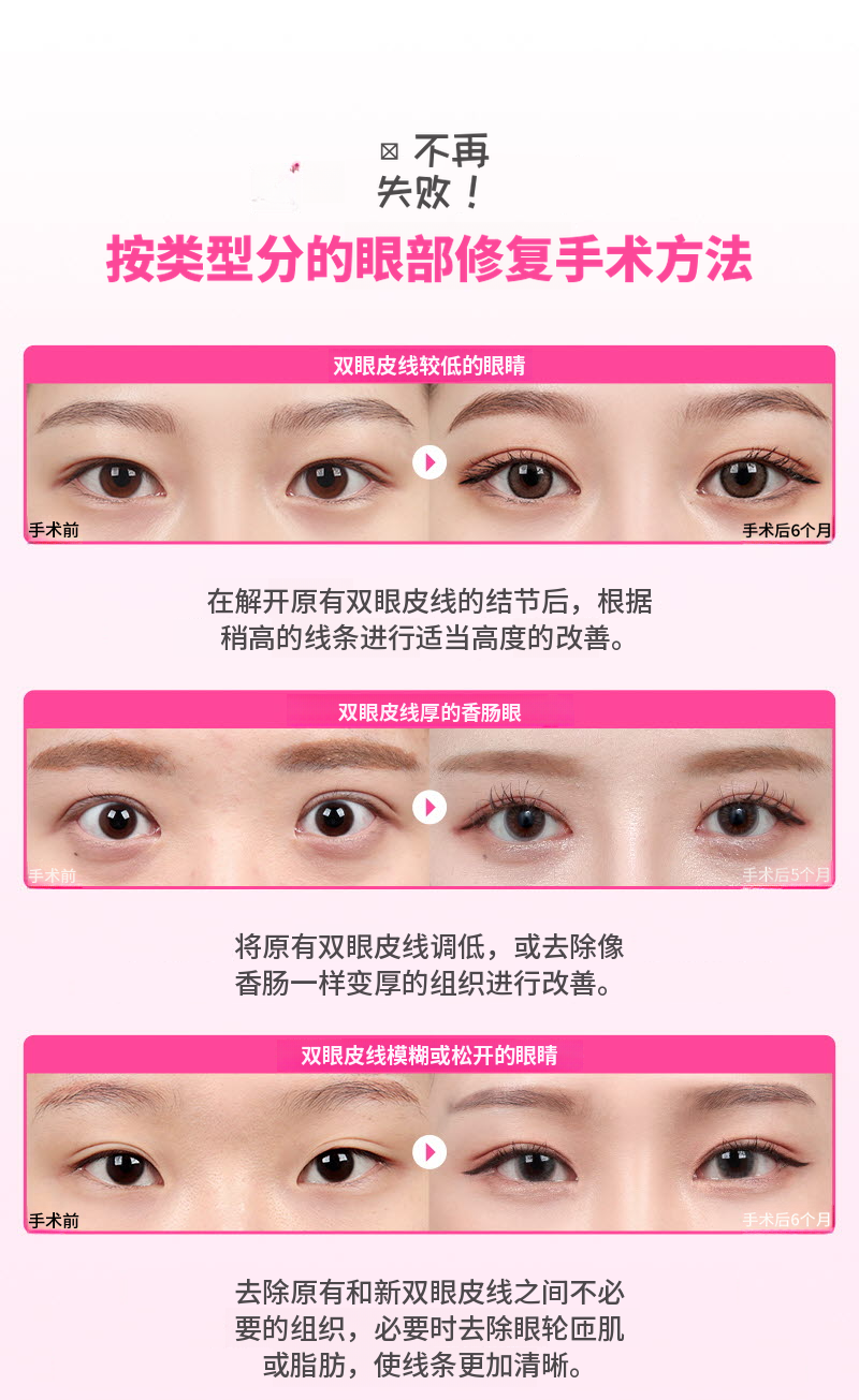 ❤️美丽❤️眼睛重建手术