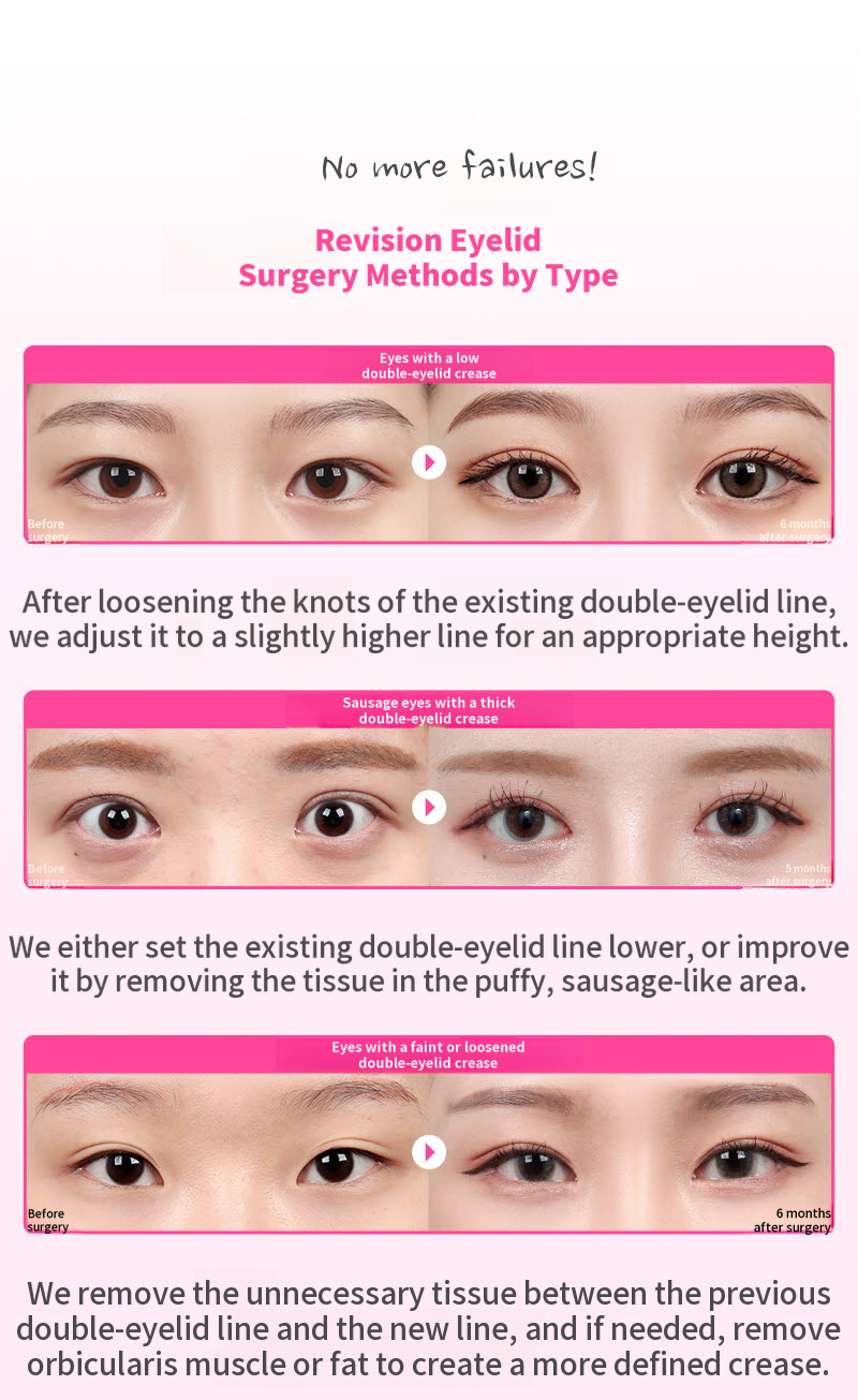 ❤️View❤️Eye Reoperation