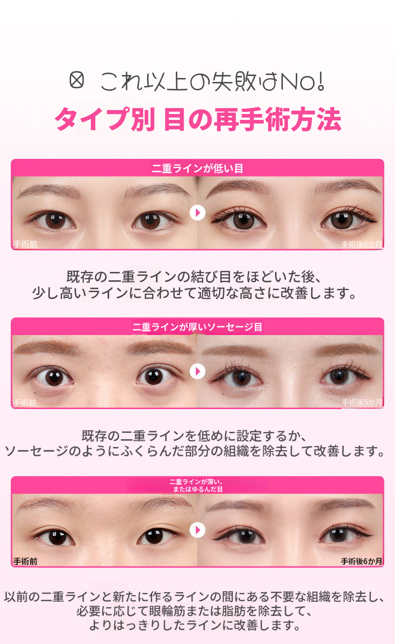 ❤️ビュー❤️目の再手術