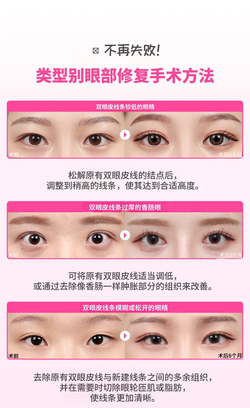 ❤️视觉❤️眼睛再手术