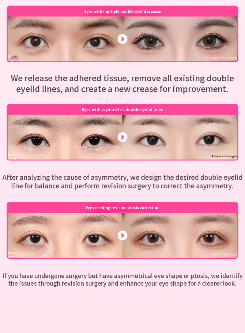 ❤️View❤️ Eye Surgery Revision