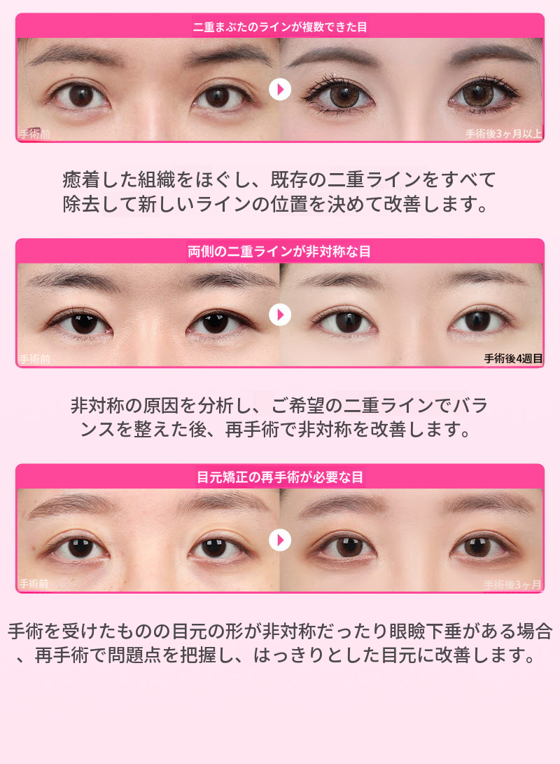 ❤️ビュ❤️目の再手術