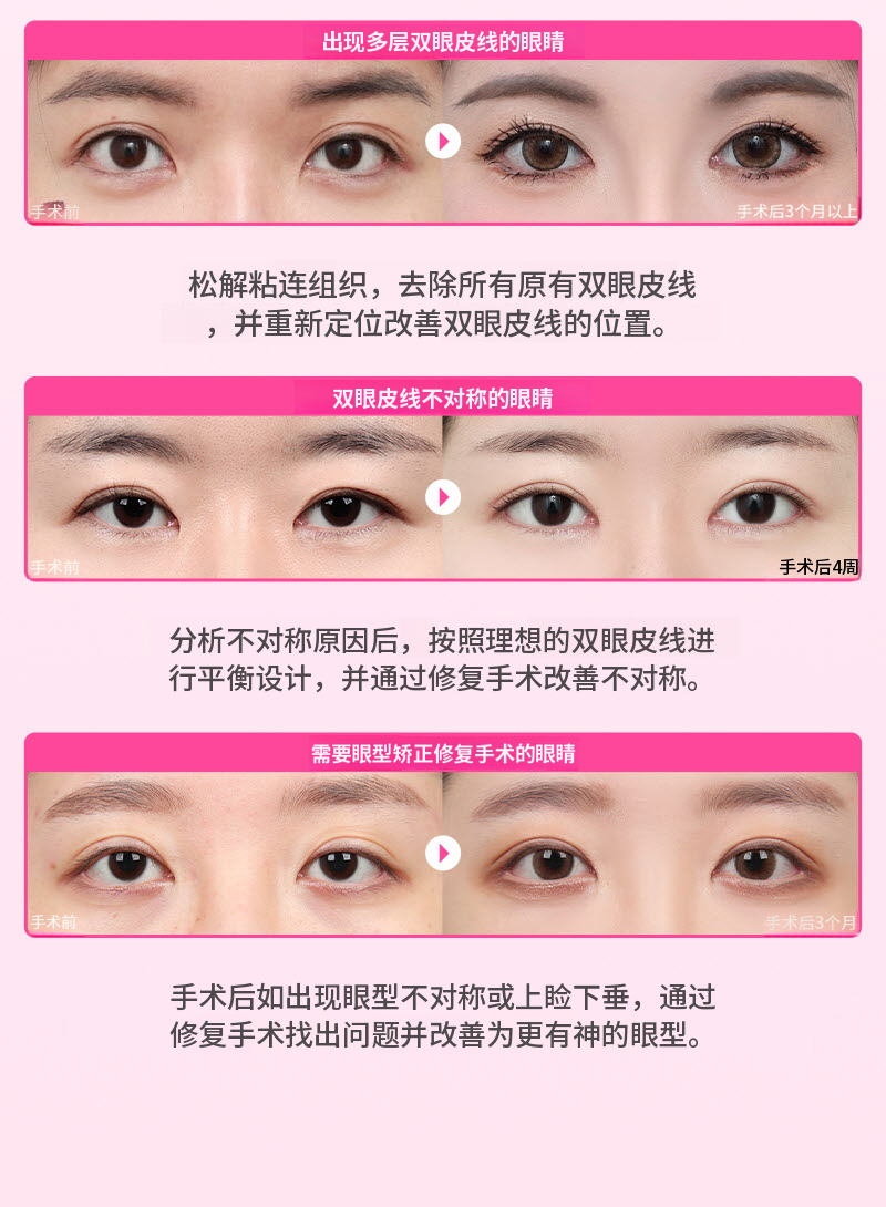 ❤️美丽❤️眼睛重建手术