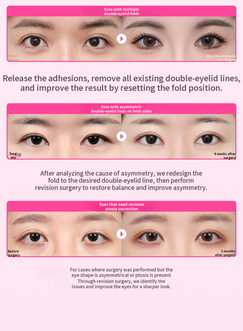 ❤️View❤️Eye Reoperation