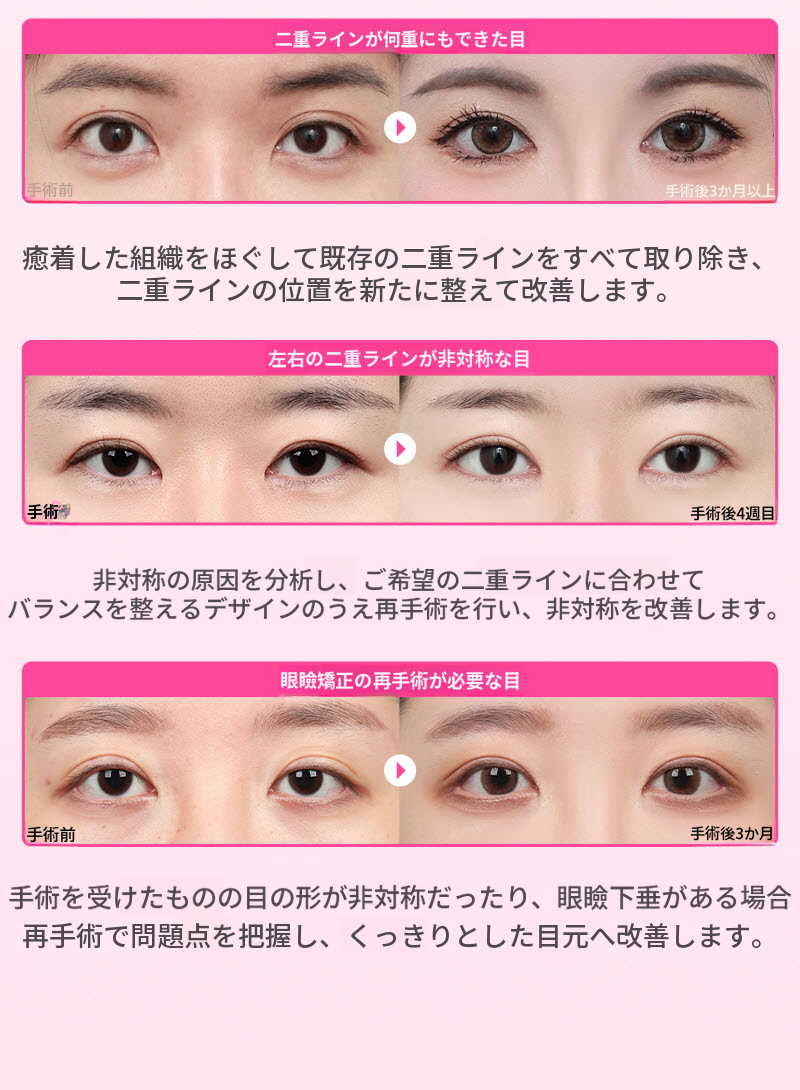 ❤️ビュー❤️目の再手術