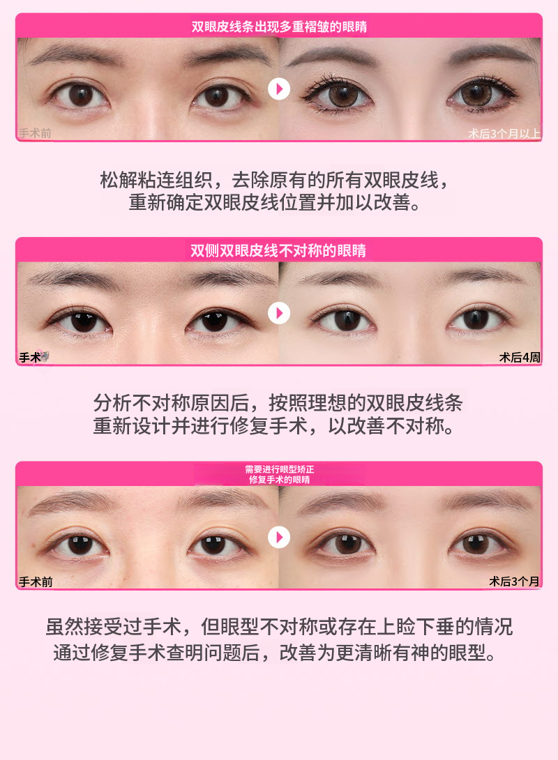 ❤️视觉❤️眼睛再手术