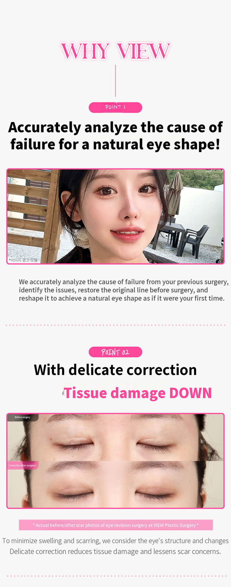 ❤️View❤️ Eye Surgery Revision