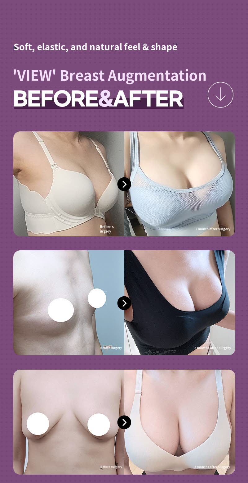 ❤️View❤️ Motiva Breast Augmentation