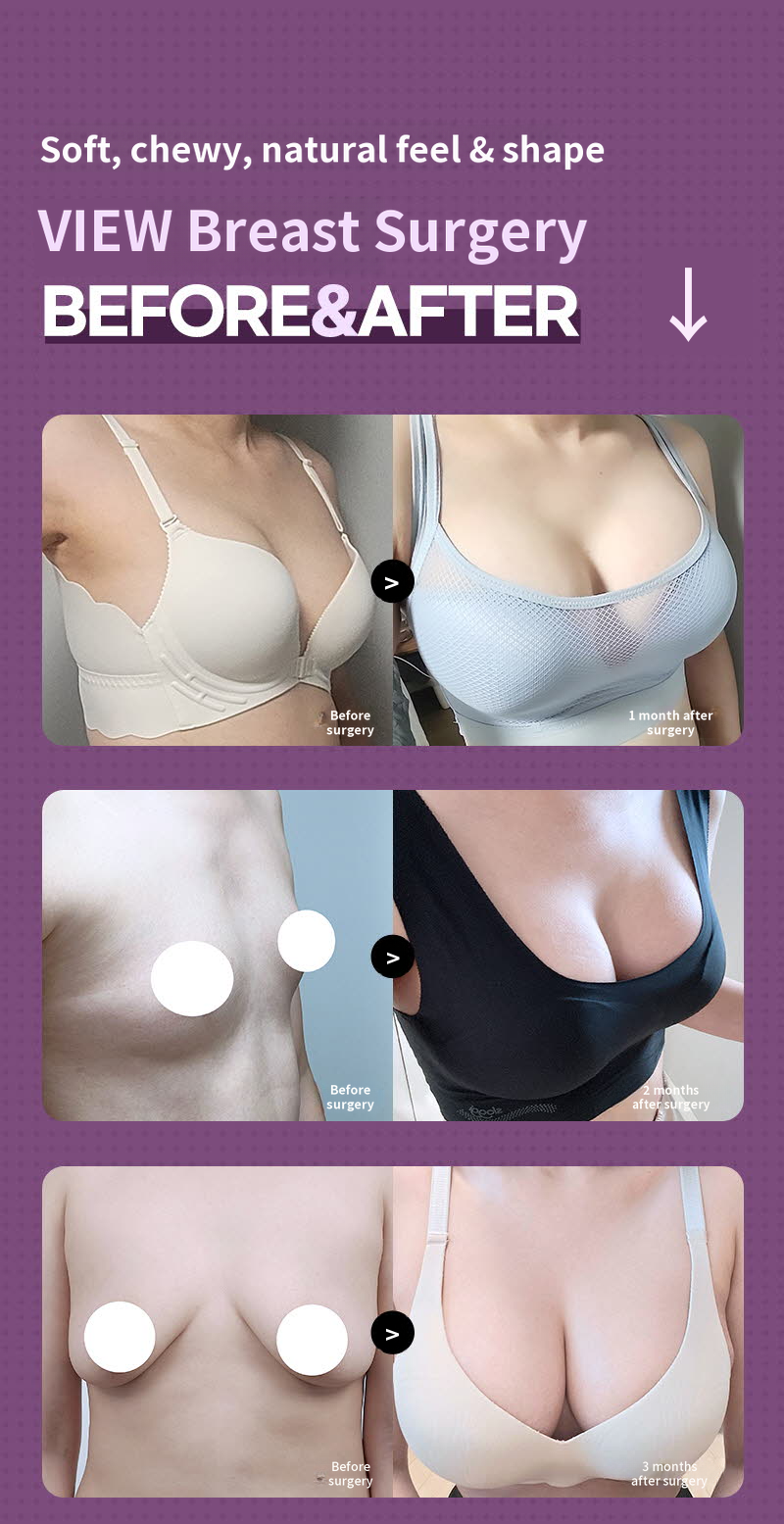 ❤️View❤️ Motiva Breast Surgery