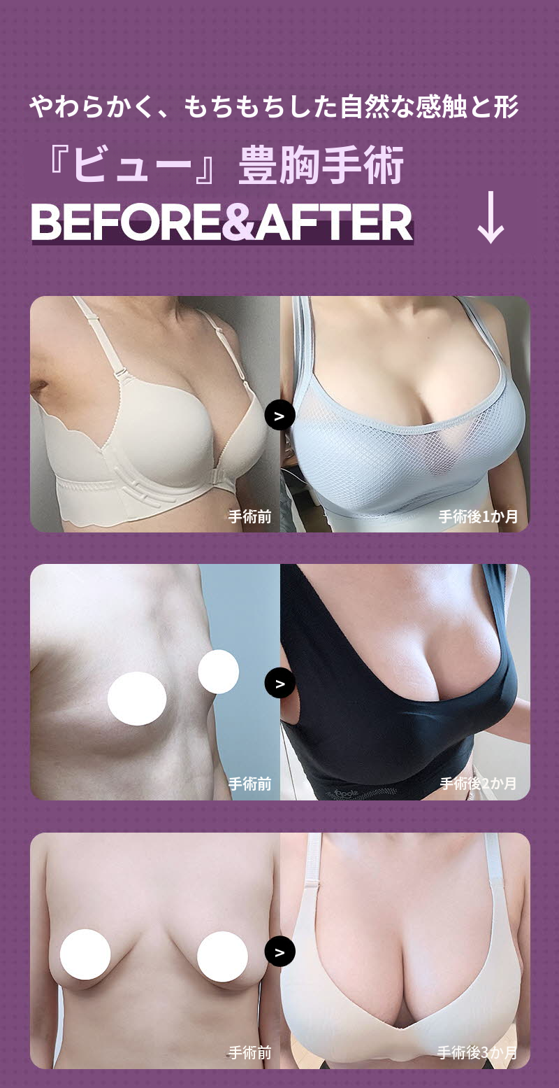 ❤️ビュー❤️ モティバ胸の整形