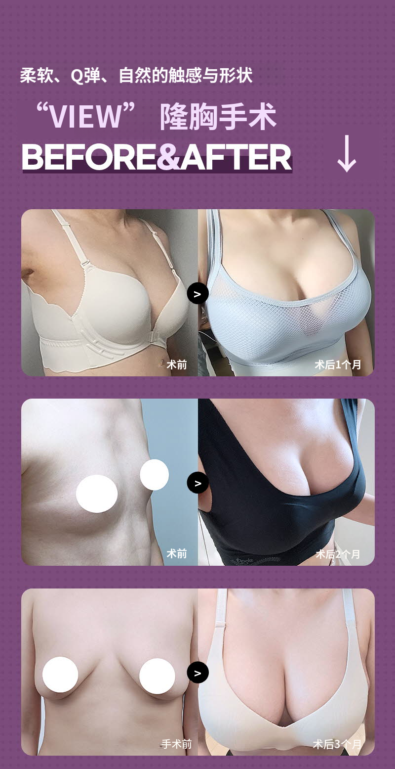 ❤️视图❤️ Motiva 胸部整形