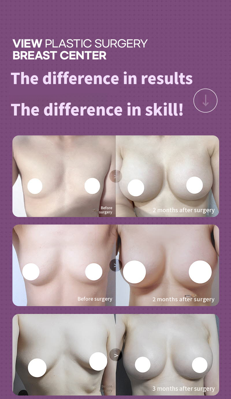 ❤️View❤️ Motiva Breast Surgery
