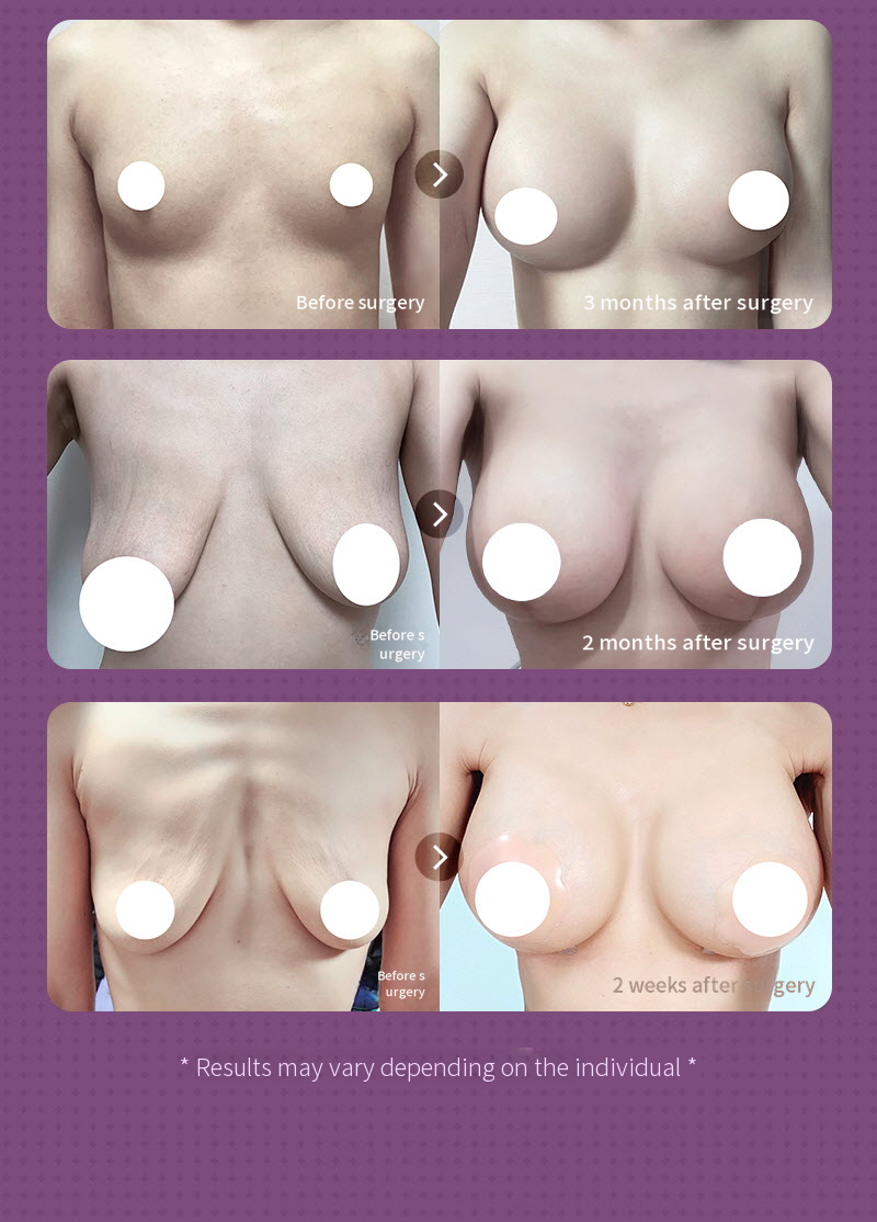 ❤️View❤️ Motiva Breast Augmentation